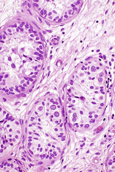 Fig. 13.14, Abnormal germ cells, some binucleated, adjacent to teratoma in a pediatric patient. These cells lack the features of GCNIS.