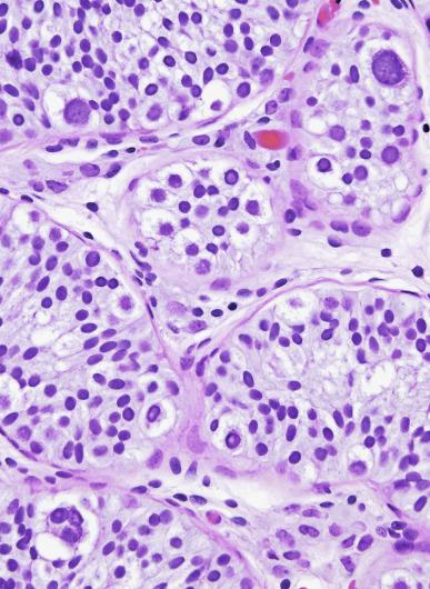 Fig. 13.15, Abnormal germ cells adjacent to teratoma in a pediatric patient. These cells lack the features of GCNIS.