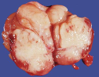 Fig. 13.16, Cut surface of a seminoma demonstrating a cream-colored, multinodular neoplasm bulging from the surrounding testicular parenchyma.