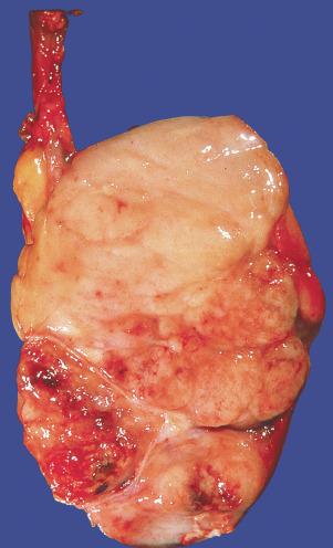 Fig. 13.17, Seminoma with a diffusely fleshy, encephaloid appearance and foci of hemorrhage.