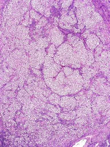 Fig. 13.18, Sheetlike pattern of a seminoma is interrupted by branching, fibrous septa containing lymphocytes.