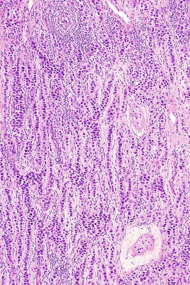 Fig. 13.19, Prominent cordlike pattern in a seminoma.