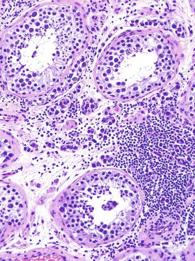 Fig. 13.20, Intertubular growth of a seminoma.