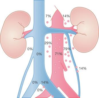 Fig. 13.2, Pattern of early retroperitoneal lymph node involvement from left-sided testicular tumors.