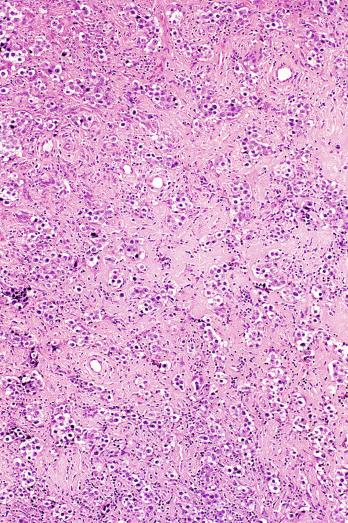 Fig. 13.21, Scarring in a seminoma creates a pattern of small nests and solid pseudotubules separated by hyalinized stroma.