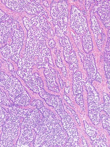 Fig. 13.22, Tubular pattern of a seminoma, with palisade-like arrangement of cells at the periphery of tubule-like structures.