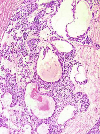 Fig. 13.23, Edema in a seminoma creating an irregular, microcystic pattern.