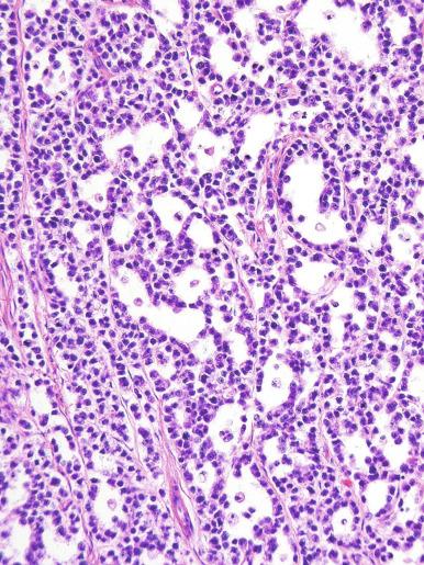 Fig. 13.24, Microcystic pattern in a seminoma.