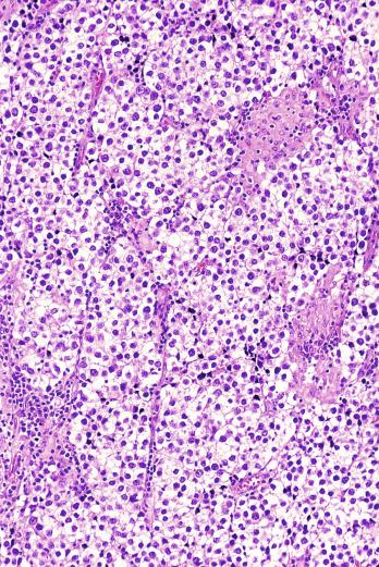 Fig. 13.25, Lymphocytes and epithelioid granulomas in a seminoma.