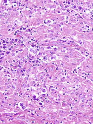 Fig. 13.26, An extensive granulomatous reaction in a seminoma, leaving only rare tumor cells.