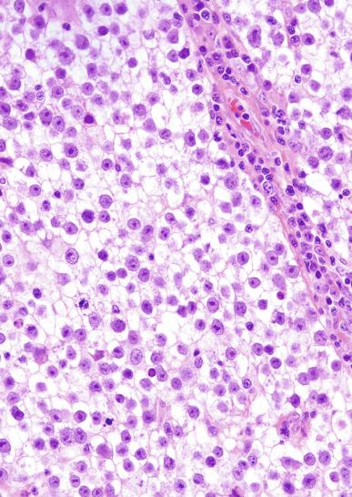 Fig. 13.27, Seminoma cells with clear cytoplasm, well-defined cell borders, and nuclei with one or two prominent nucleoli. Lymphocytes are present in a fibrous septum, and some tumor nuclei have “squared-off” edges.