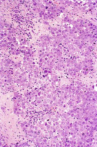 Fig. 13.28, Seminoma with increased nuclear pleomorphism and crowding and denser cytoplasm than usual.