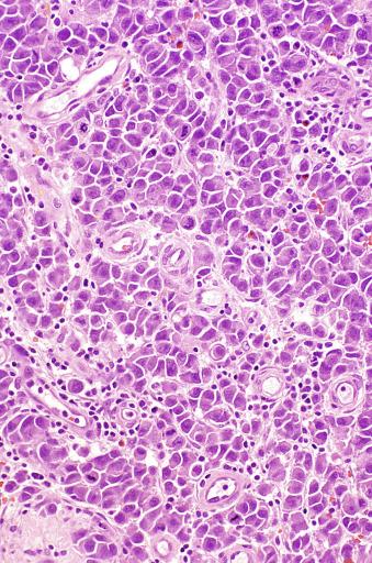 Fig. 13.29, Plasmacytoid seminoma. Many cells have dense cytoplasm and eccentric nuclei.