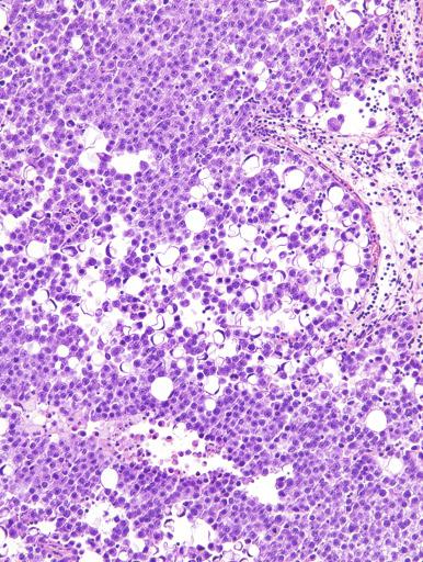 Fig. 13.30, Seminoma with signet ring cells.