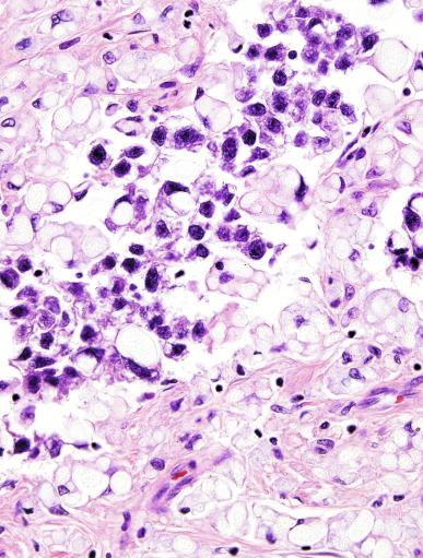 Fig. 13.31, Seminoma with prominent aggregates of glycogen creating a signet ring cell appearance. Many histiocytes with phagocytosed glycogen aggregates are also present.