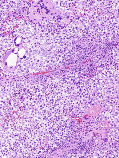 Fig. 13.32, Seminoma with syncytiotrophoblast cells.