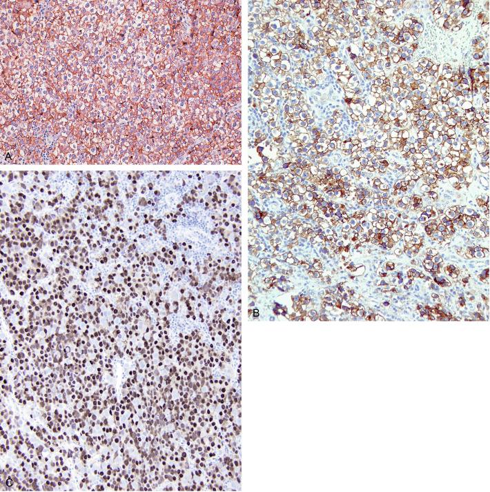 Fig. 13.34, Seminoma showing a membranous pattern of positivity for (A) placental alkaline phosphatase and (B) c-kit (CD117). (C) Strong nuclear reactivity for OCT3/4 in seminoma.