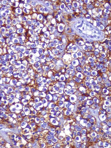 Fig. 13.35, Membranous podoplanin staining in a seminoma.