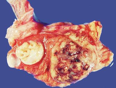 Fig. 13.36, The large yellow-tan nodule is embryonal carcinoma, showing areas of hemorrhage and necrosis.