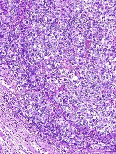 Fig. 13.37, Embryonal carcinoma with a solid pattern.