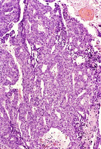 Fig. 13.38, Embryonal carcinoma with a glandular pattern.