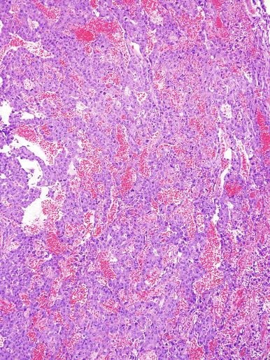 Fig. 13.39, Embryonal carcinoma with an anastomosing pattern.