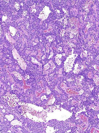 Fig. 13.40, Embryonal carcinoma with a sievelike pattern.