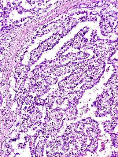 Fig. 13.41, Embryonal carcinoma with a papillary pattern.