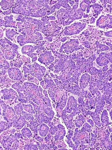 Fig. 13.42, Embryonal carcinoma with papillary structures with central blood vessels resembling the endodermal sinus pattern of a yolk sac tumor.