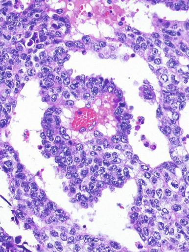 Fig. 13.43, Embryonal carcinoma with an endodermal sinuslike pattern at high magnification. The arrangement of tumor cells around the blood vessels resembles a Schiller-Duval body.