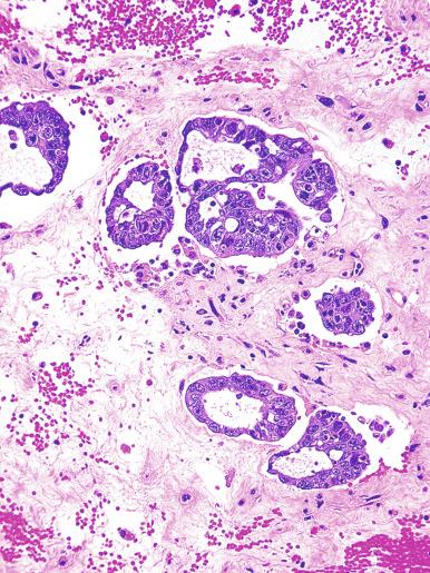 Fig. 13.44, Embryonal carcinoma with a blastocyst-like pattern with tumor cell nests with a central vesicle-like space.