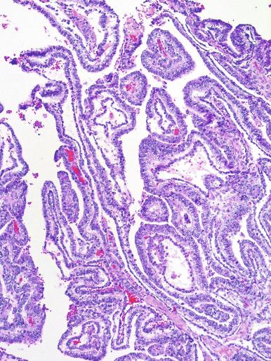 Fig. 13.45, The “double-layered” pattern of embryonal carcinoma, consisting of ribbons of embryonal carcinoma with a parallel layer of flattened cells. This is classified as mixed germ cell tumor, sometimes termed diffuse embryoma, and consists of embryonal carcinoma and yolk sac tumor (the flattened layer).