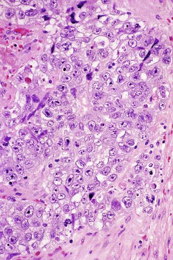 Fig. 13.46, Embryonal carcinoma.