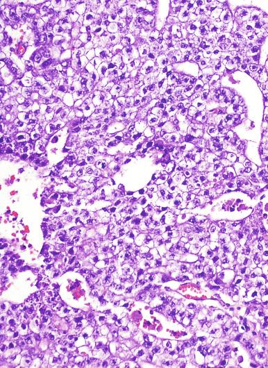 Fig. 13.47, Embryonal carcinoma with seminoma-like cells.