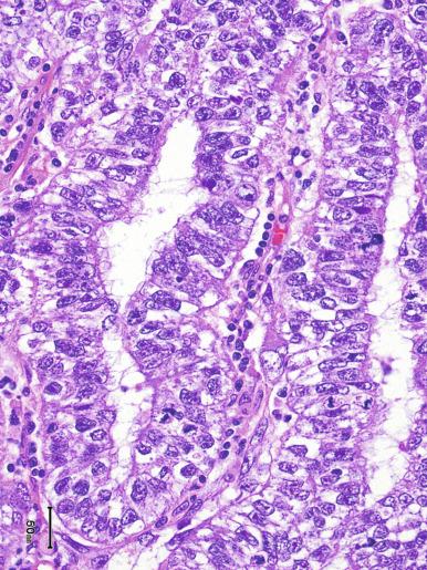 Fig. 13.48, Embryonal carcinoma with columnar cells resembling teratoma.