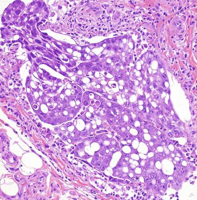 Fig. 13.49, Embryonal carcinoma with prominent cytoplasmic vacuolization (lipoid appearance).