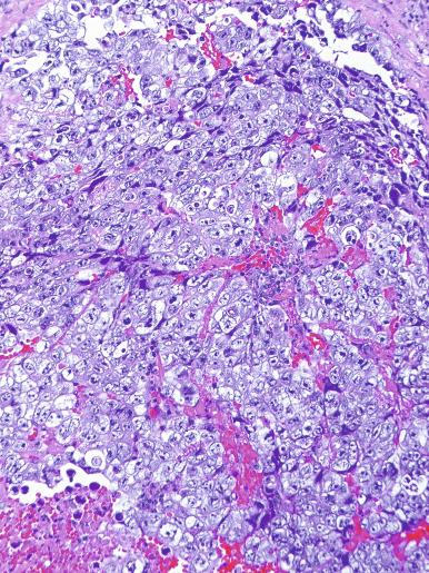 Fig. 13.50, Solid pattern of embryonal carcinoma with degenerate, smudged cells (appliqué pattern) and focal necrosis.