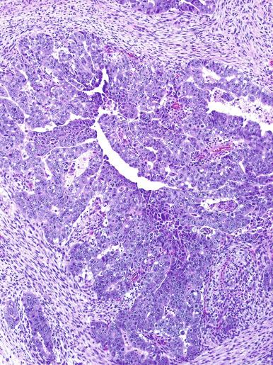 Fig. 13.51, Neoplastic stroma in an embryonal carcinoma.