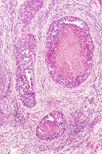 Fig. 13.53, Intratubular embryonal carcinoma with characteristic abundant necrosis.