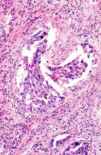 Fig. 13.54, Intratubular embryonal carcinoma can be reliably distinguished from vascular invasion if there are residual Sertoli cells.