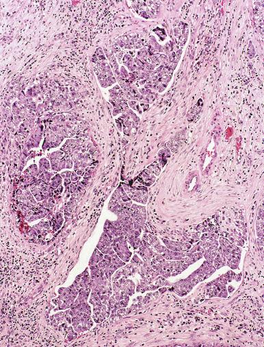 Fig. 13.55, Vascular invasion that was peripheral to embryonal carcinoma. Note the branching pattern.