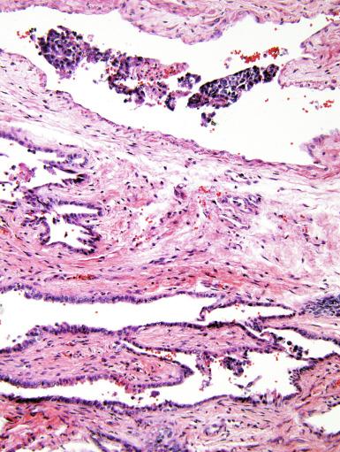 Fig. 13.56, Artifactual “knife implantation” of tumor groups into vascular spaces. Note the loose tumor cell groups unassociated with vascular thrombosis.