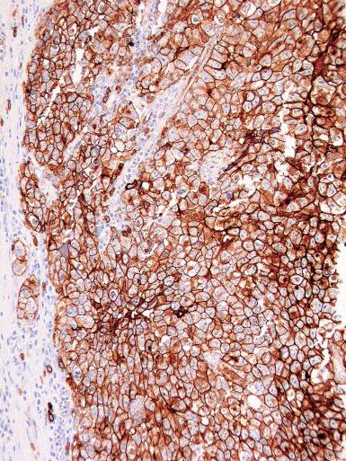 Fig. 13.57, Immunostaining for CD30 in embryonal carcinoma with strong membrane reactivity.