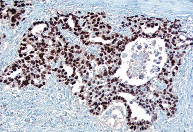 Fig. 13.58, Immunostaining for OCT3/4 in embryonal carcinoma showing strong nuclear positivity.