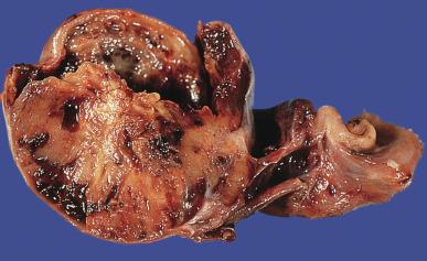 Fig. 13.59, Yolk sac tumor, postpubertal-type, showing hemorrhage, cystic degeneration, and myxoid change.