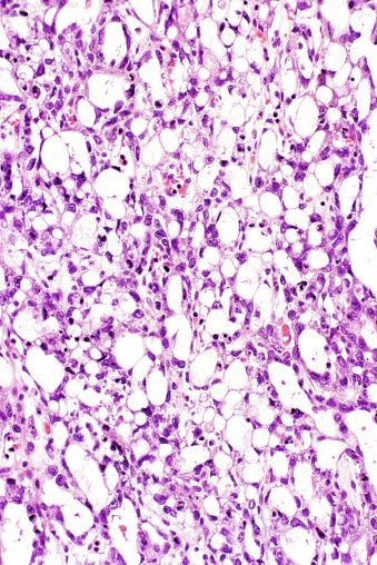 Fig. 13.60, Microcystic pattern of a yolk sac tumor resulting from intracellular vacuoles.