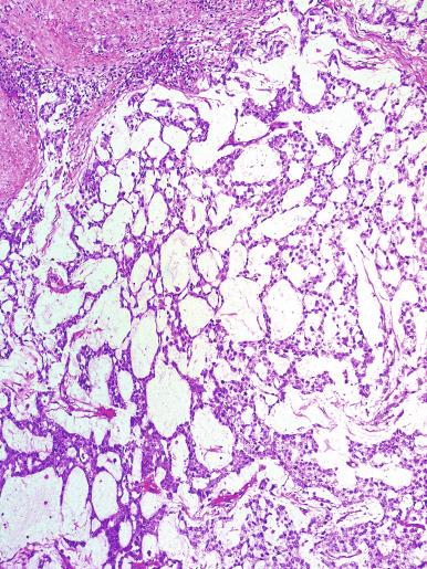 Fig. 13.61, Microcystic pattern of a yolk sac tumor created by cords of cells surrounding extracellular space (also referred to as reticular pattern).