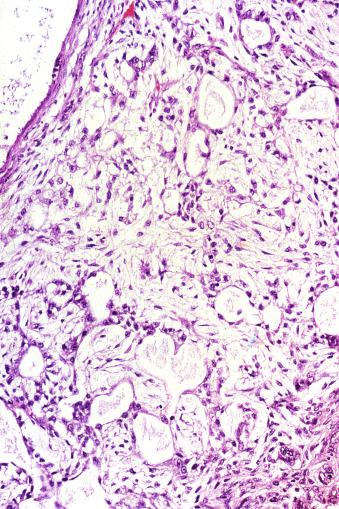 Fig. 13.62, Blending of microcystic and myxoid patterns of a yolk sac tumor. Neoplastic cells appear to “bud” from microcystic structures and blend into a myxoid stroma.