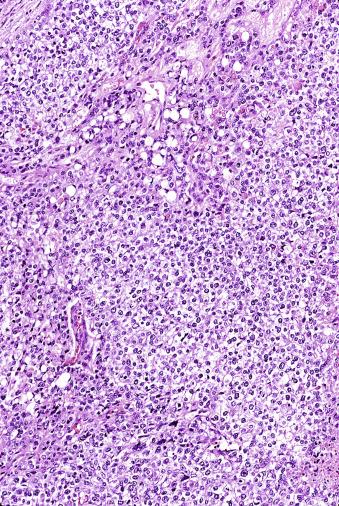 Fig. 13.63, Mixture of solid and microcystic patterns of a yolk sac tumor.