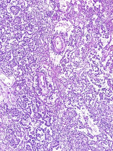 Fig. 13.64, Endodermal sinus pattern of a yolk sac tumor.